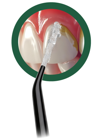 LACLEVER - nástavec tryska